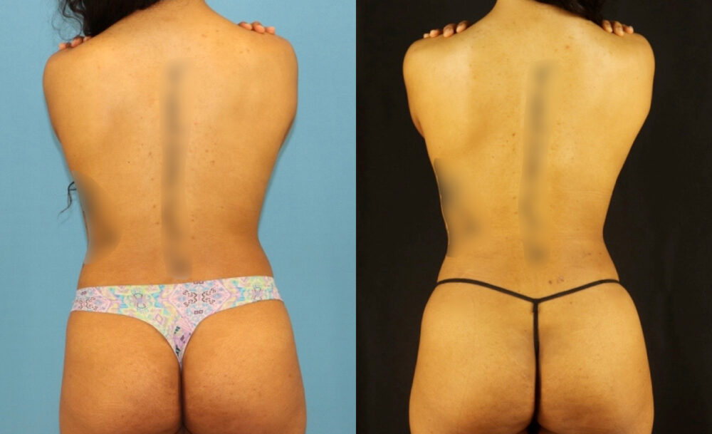 Fat Grafting to the Breast case #256207