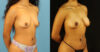 Fat Grafting to the Breast case #256207 slider thumbnail