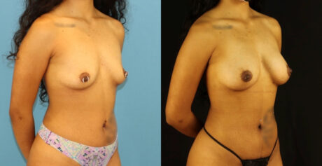 Fat Grafting to the Breast case #256207