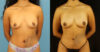 Fat Grafting to the Breast case #256207 slider thumbnail