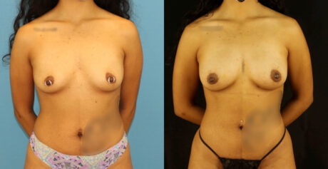 Fat Grafting to the Breast case #256207