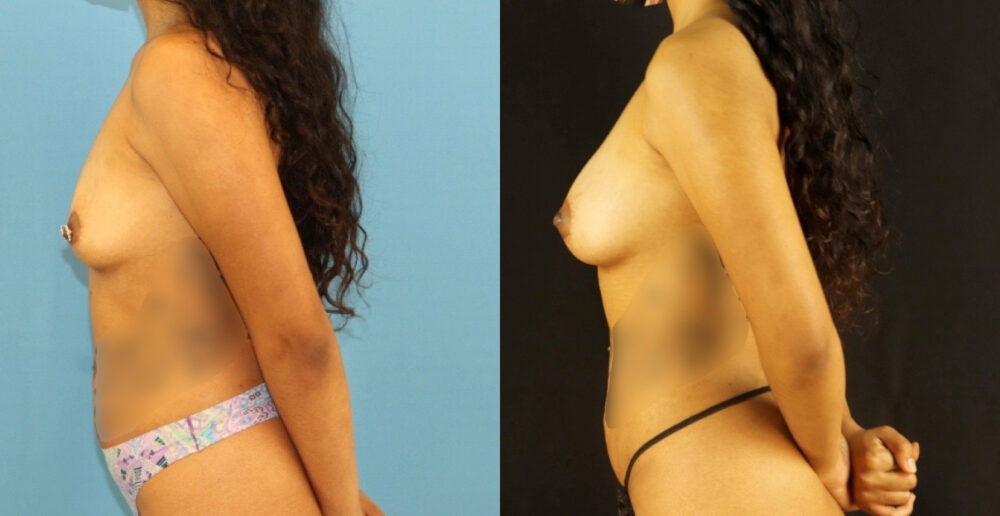 Fat Grafting to the Breast case #256207