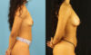 Fat Grafting to the Breast case #256207 slider thumbnail