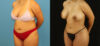 Brazilian Butt Lift case #5168 slider thumbnail