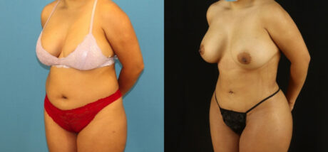 Brazilian Butt Lift case #5168