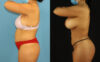 Brazilian Butt Lift case #5168 slider thumbnail