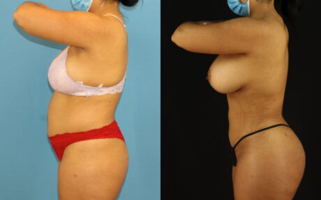 Brazilian Butt Lift case #5168