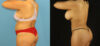 Brazilian Butt Lift case #5168 slider thumbnail