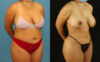 Brazilian Butt Lift case #5168 slider thumbnail
