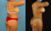 Brazilian Butt Lift case #5168 slider thumbnail