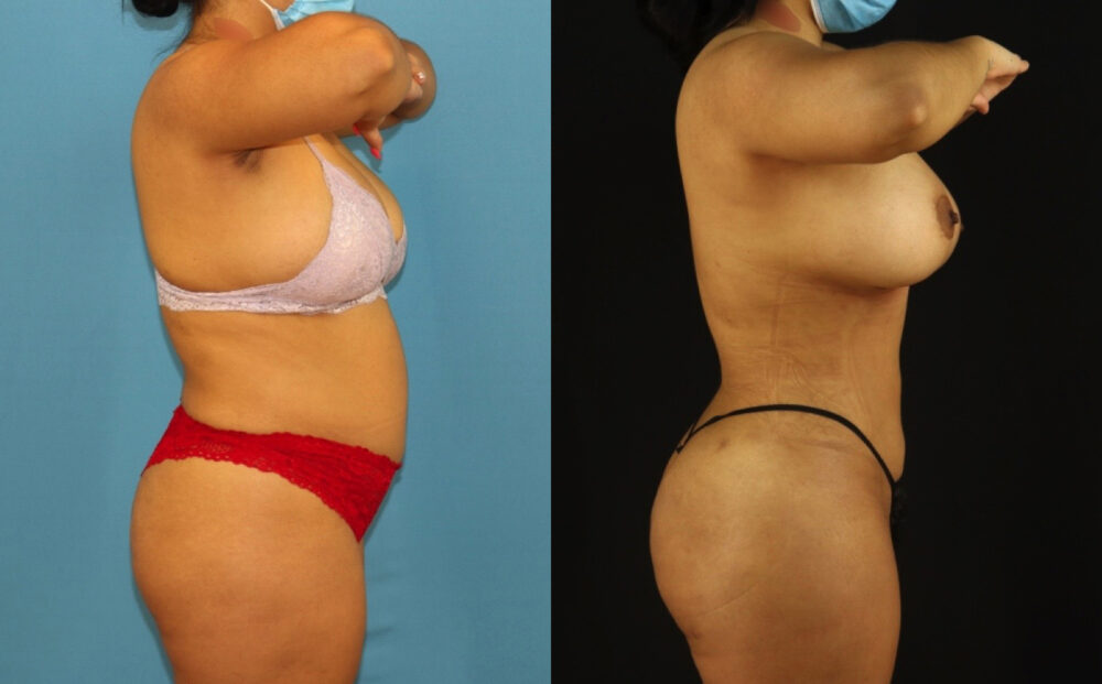 Brazilian Butt Lift case #5168