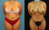Brazilian Butt Lift case #5168 slider thumbnail