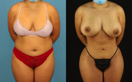 Brazilian Butt Lift case #5168