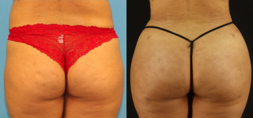 Brazilian Butt Lift case #5168