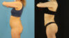 Brazilian Butt Lift case #5169 slider thumbnail