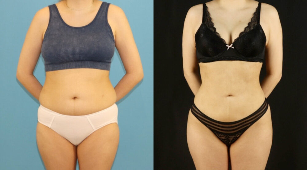 Brazilian Butt Lift case #5169