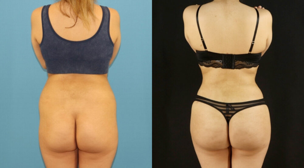 Brazilian Butt Lift case #5169