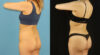 Brazilian Butt Lift case #5169 slider thumbnail