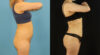 Brazilian Butt Lift case #5169 slider thumbnail