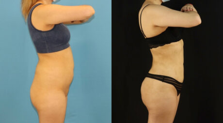 Brazilian Butt Lift case #5169