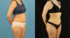 Brazilian Butt Lift case #5169 slider thumbnail