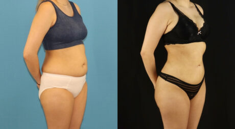 Brazilian Butt Lift case #5169