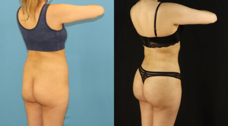Brazilian Butt Lift case #5169