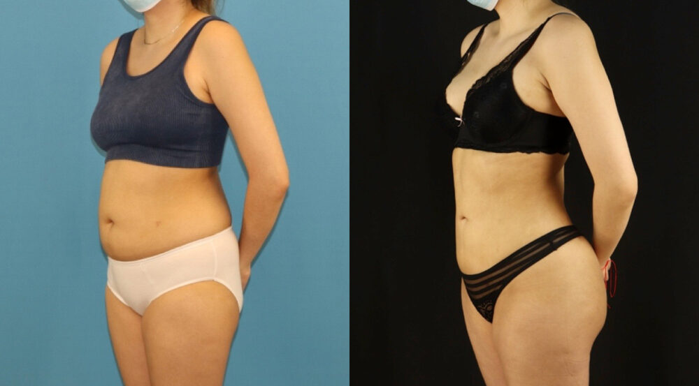Brazilian Butt Lift case #5169
