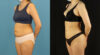 Brazilian Butt Lift case #5169 slider thumbnail