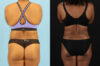 Liposuction case #6013 slider thumbnail