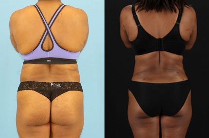 Liposuction case #6013