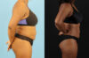 Liposuction case #6013 slider thumbnail