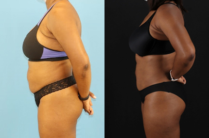 Liposuction case #6013