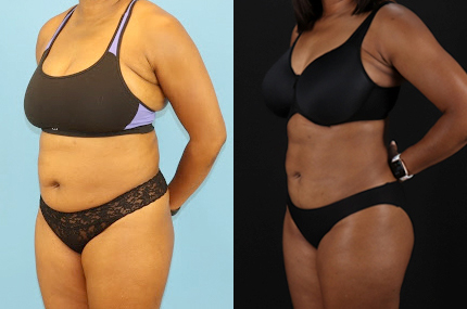 Liposuction case #6013