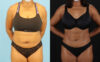 Liposuction case #6013 slider thumbnail