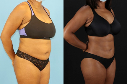 Liposuction case #6013