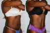 Tummy Tuck case #7163 slider thumbnail