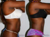 Tummy Tuck case #7163 slider thumbnail