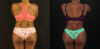 Tummy Tuck case #7282 slider thumbnail