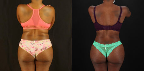 Tummy Tuck case #7282