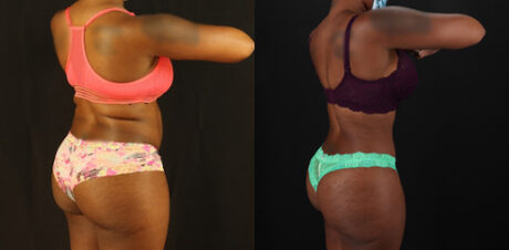 Tummy Tuck case #7282