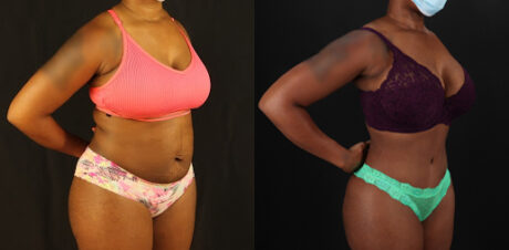 Tummy Tuck case #7282