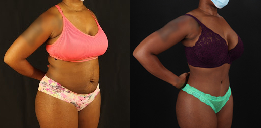 Tummy Tuck case #7282