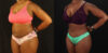 Tummy Tuck case #7282 slider thumbnail