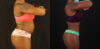 Tummy Tuck case #7282 slider thumbnail