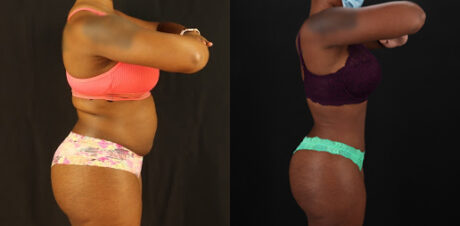 Tummy Tuck case #7282