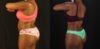 Tummy Tuck case #7282 slider thumbnail