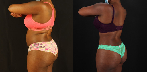 Tummy Tuck case #7282
