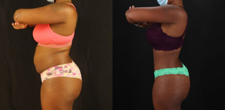 Tummy Tuck case #7282