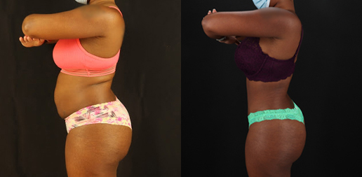 Tummy Tuck case #7282